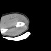 SPORK, NICO - 22.03.1976 - 02.08.2022 - CT obere Extremität - 17:56:57